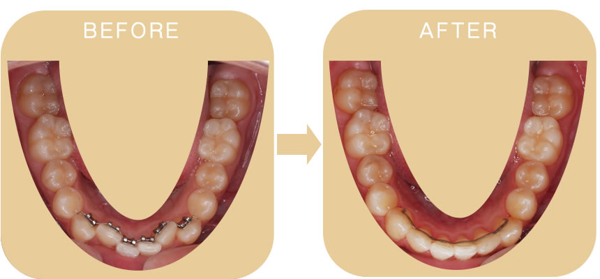 前歯6本部分矯正　下顎