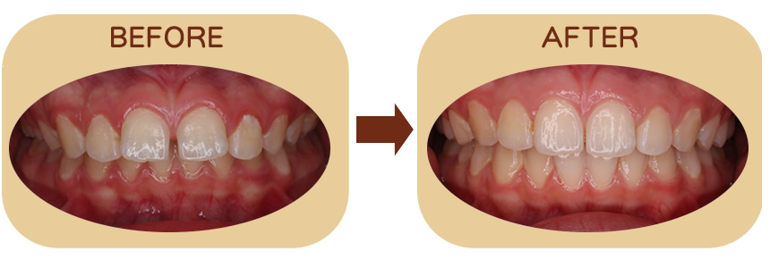 前歯の隙間治療　正面
