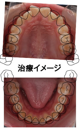出っ歯を防ぐ　治療イメージ